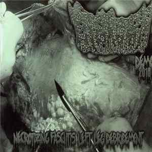 Ingrown - Necrotizing Fascitis Left Leg Debridement FLAC