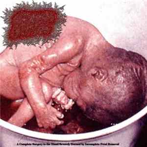 Clogged Orifice - A Complete Surgery to the Hand Severely Burned by Incomplete Fetal Removal FLAC